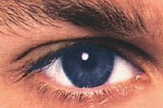 320 bin kişinin gözü, her an kör olabilir