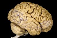 İran'da Beyin Ameliyatı Yapan Robot