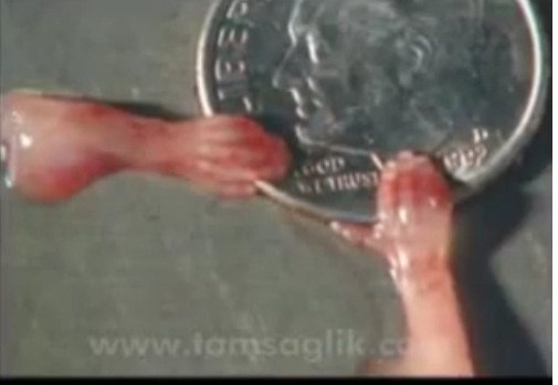 Kürtaj'dan Geriye Kalanlar ( 18+ )