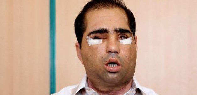 Yüz nakli olan Salih Üslün hayatını kaybetti