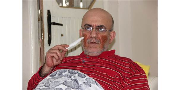 Yüzünde Çıkan Yaralar Nedeniyle Günden Güne Eriyor